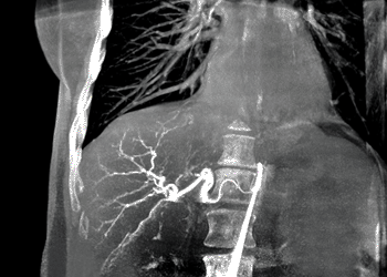 Imagen: El software syngo DynaCT 360 de Siemens acelera la angiografía rotativa (Foto cortesía de Siemens Healthcare).